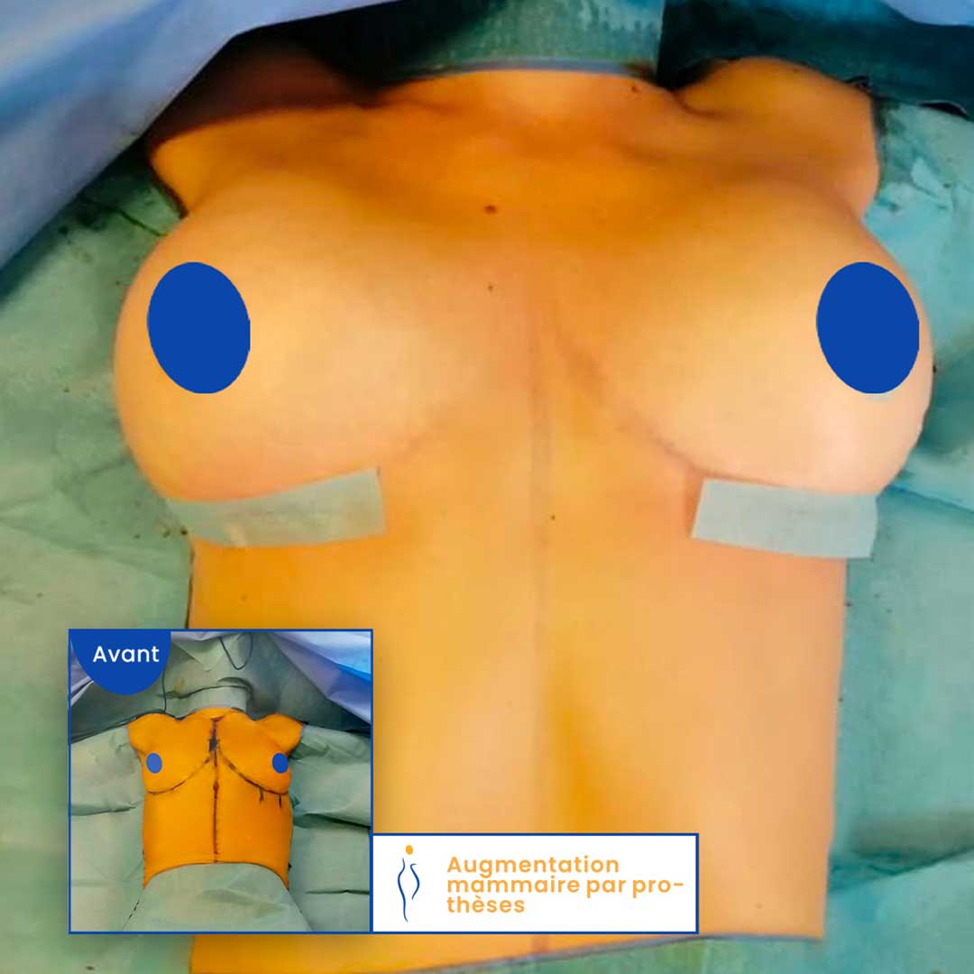 augmentation mammaire avec prothèses avant apres
