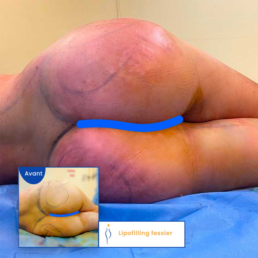 Brazilian Butt Lift avant après