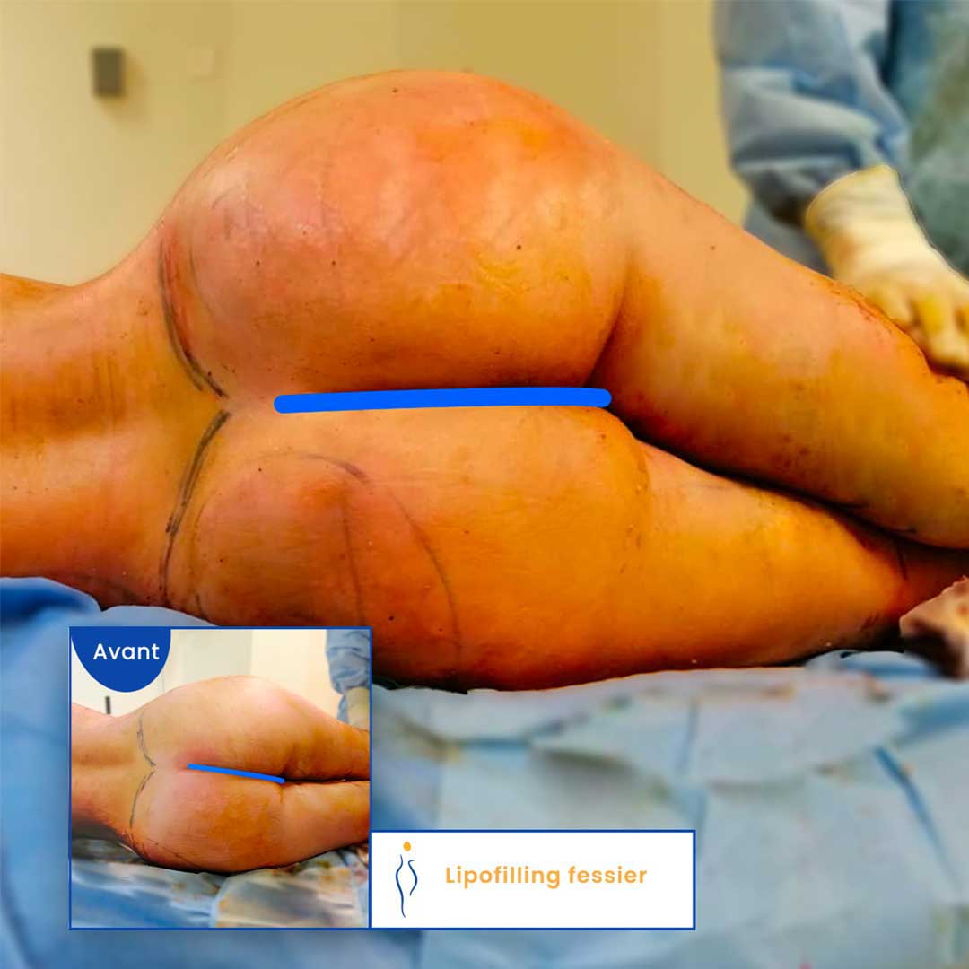 lipofilling des fesses avant après