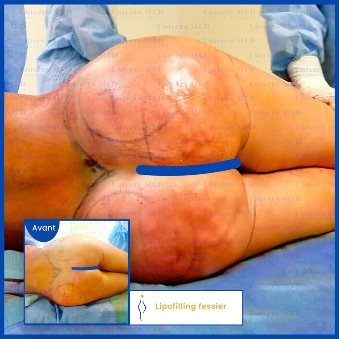 lipofilling fessier resultat definitif