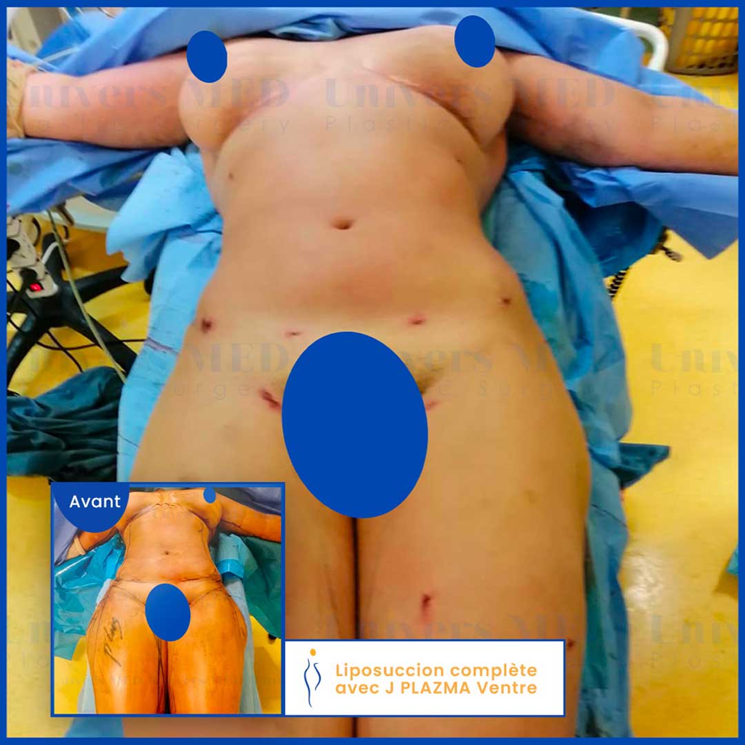 liposuccion complète avec j-plasma ventre