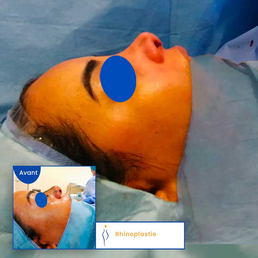 Rhinoplastie avant après