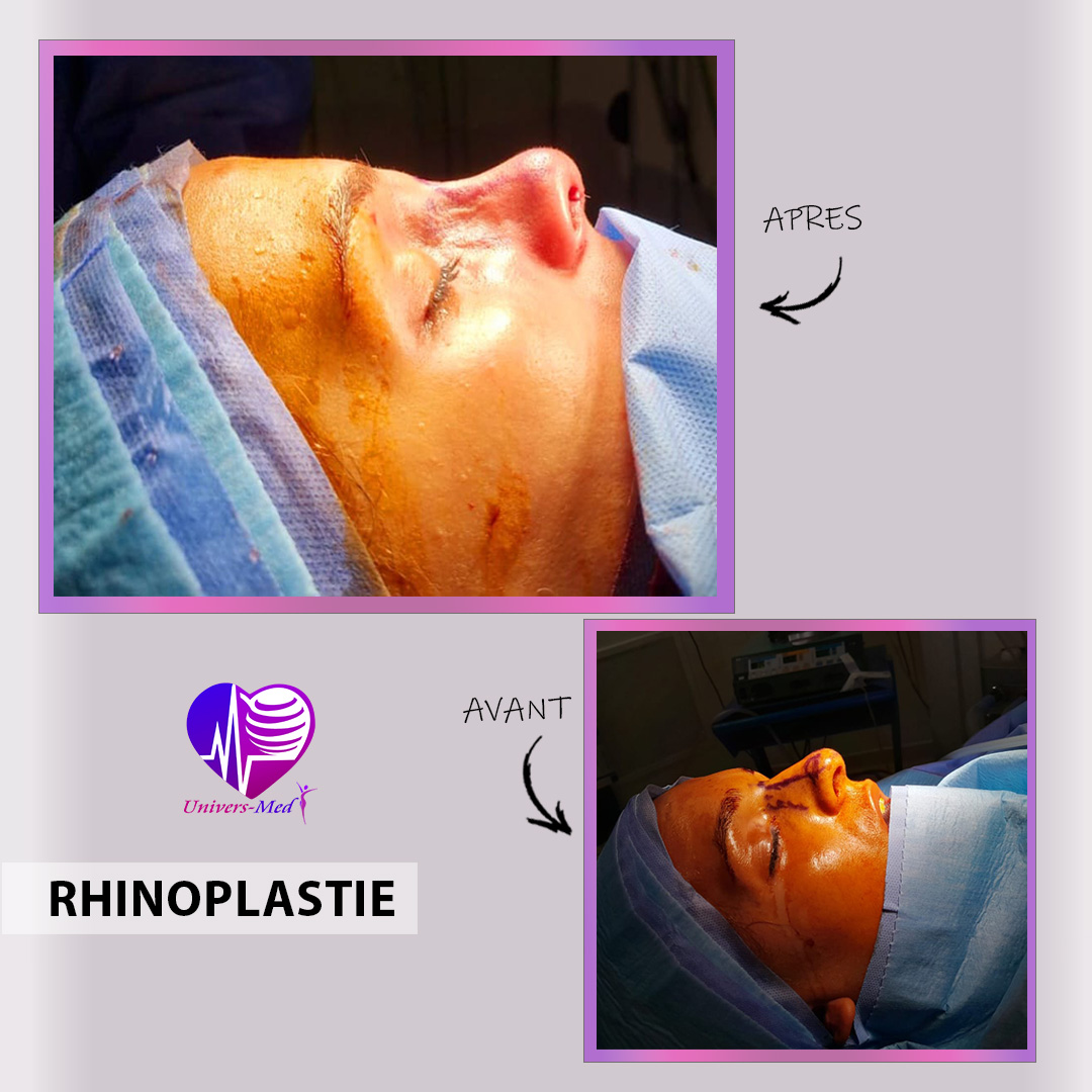 rhinoplastie avant apres tunisie