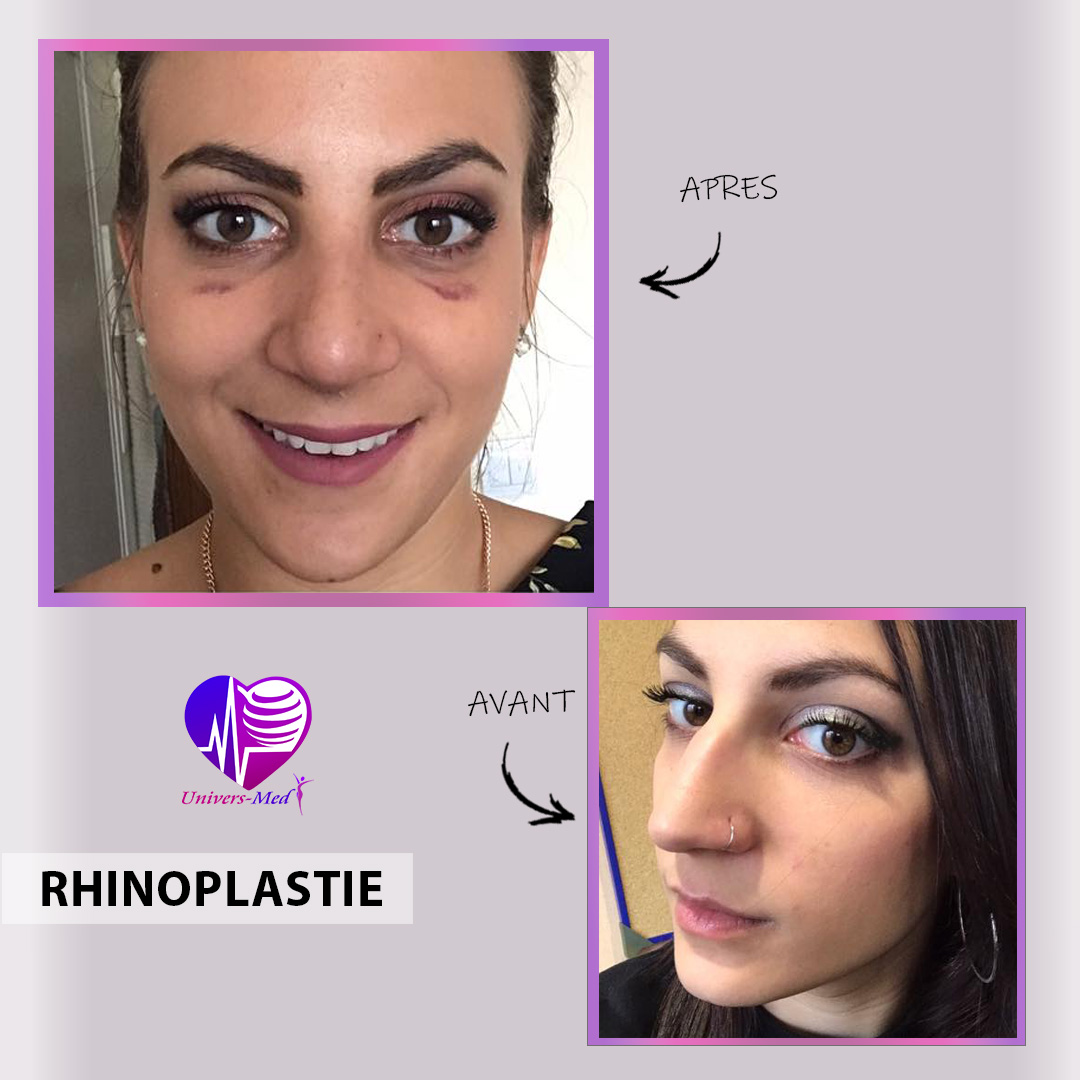 rhinoplastie tunisie avant après