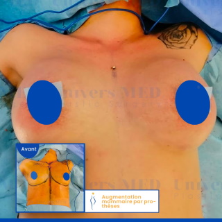 Augmentation mammaire avant après Tunisie