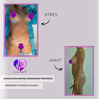 liposuccion ventre changement prothèses mammaire prothèses rondes