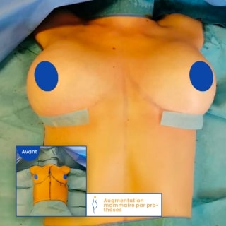 implant mammaire avant après