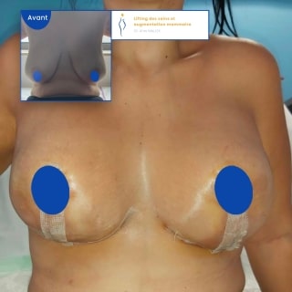 quel imc pour lipofilling des seins avant apres