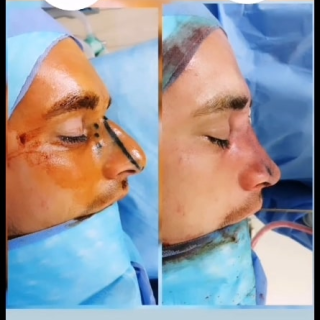 photos chirurgie du nez en Tunisie avant après