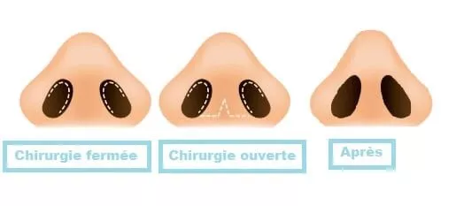 Les différents types de rhinoplastie en Tunisie