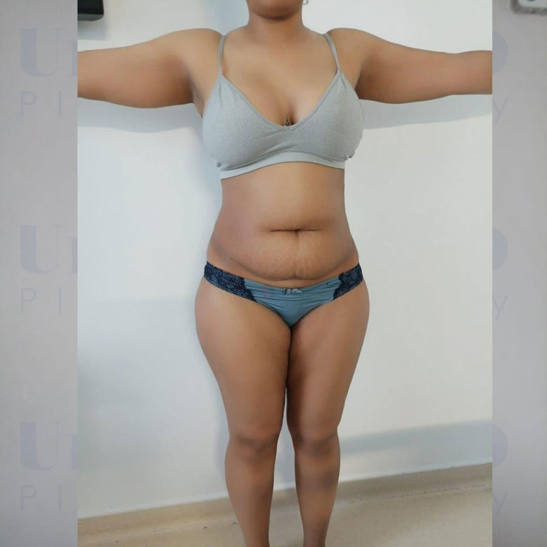 photos avant apres chirurgie esthétique