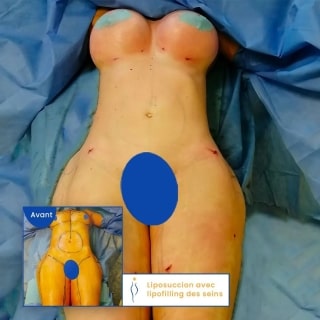 photo augmentation mammaire sans prothèses avant apres